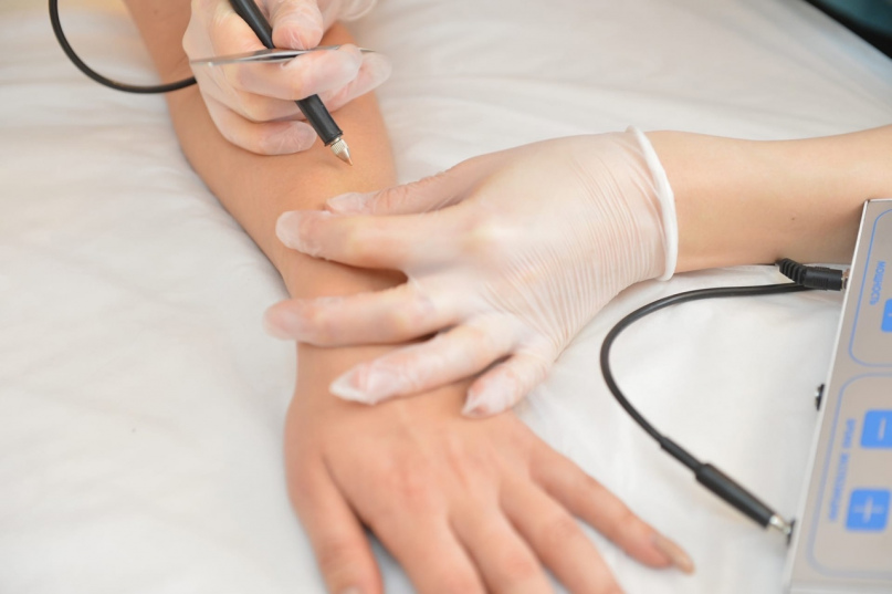 Электроэпиляция в Самаре | Элекроэпиляция - единственный метод ...