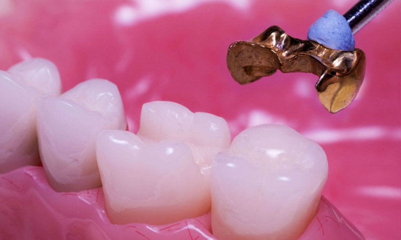 Вкладки картинки. Микропротезы виниры вкладки стоматология. Керамическая культевая вкладка. Коронка металлокерамическая Vita VM-13. Микропротезирование (вкладка-коронка). Вкладки картинки. Микропротезы виниры вкладки стоматология. Керамическая культевая вкладка. Коронка металлокерамическая Vita VM-13. Микропротезирование (вкладка-коронка).